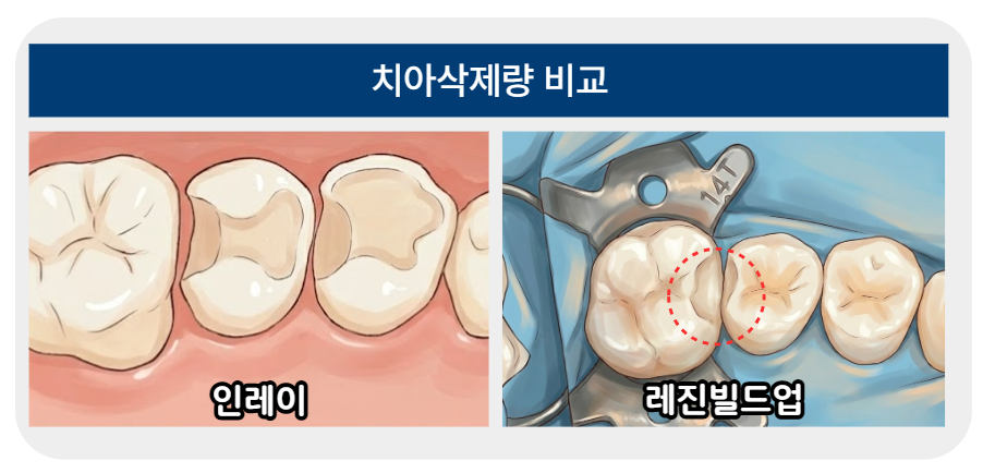 인레이 레진빌드업 치아삭제량 비교