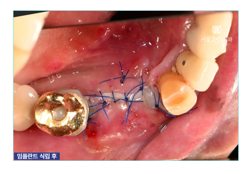 임플란트 식립 후 봉합한 모습