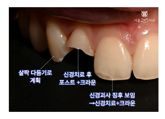 앞니부러짐 치료계획