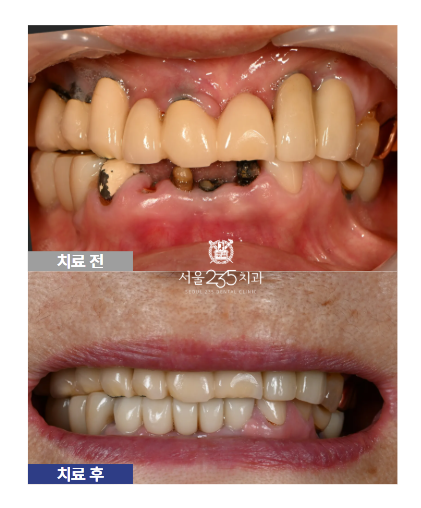 80대 임플란트 치료전후 사진
