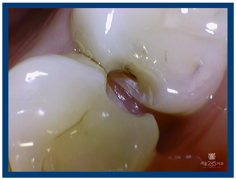 어금니 까만점 인접면충치 삭제한 모습