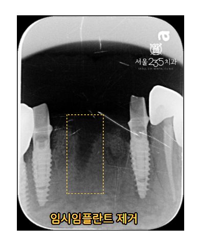 임시 임플란트 제거 PA