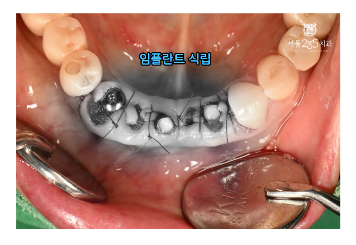 아래 앞니 임플란트 식립한 모습