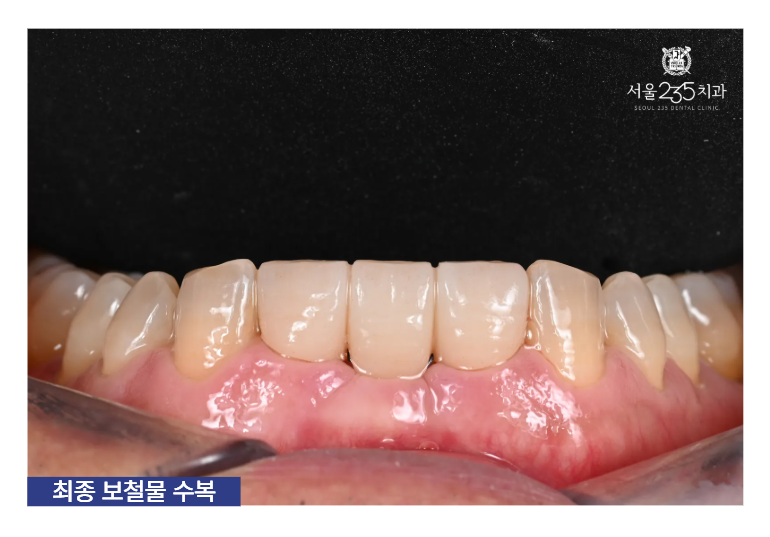 아랫니 브릿지 치료결과