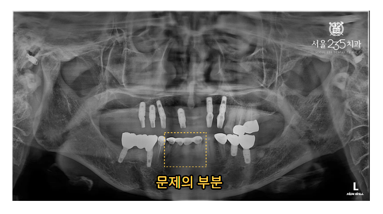 아래앞니 보철물 빠짐