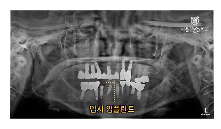 임시 임플란트 식립한 모습