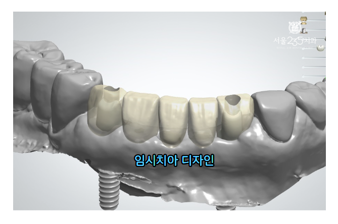 임시치아 디자인