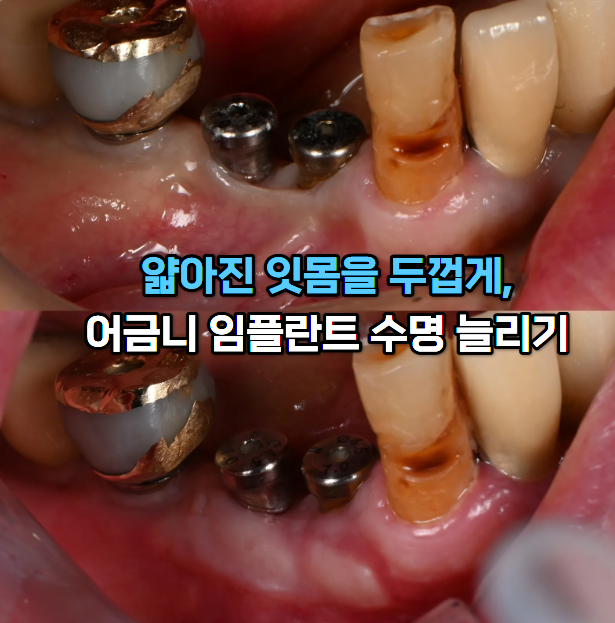 잇몸이식 치료전후