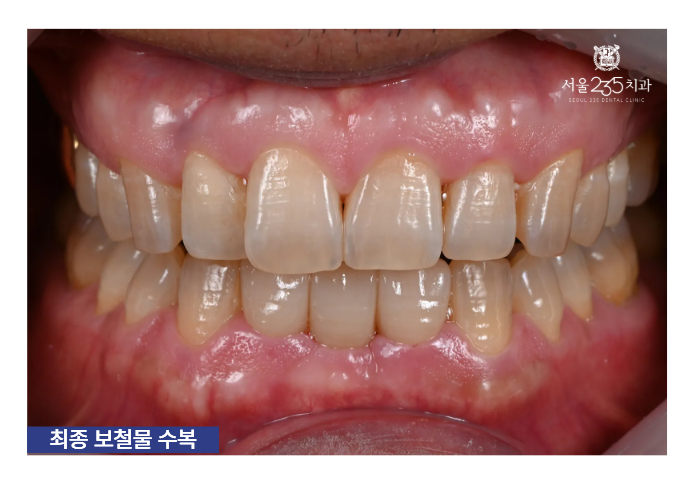 아랫니흔들림 브릿지 치료 후 최종보철물 세팅