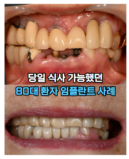 아래앞니부러짐, 앞니임플란트