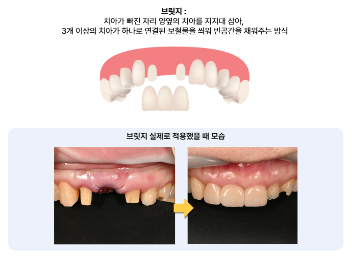 앞니브릿지 설명