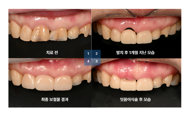 앞니브릿지 치료과정