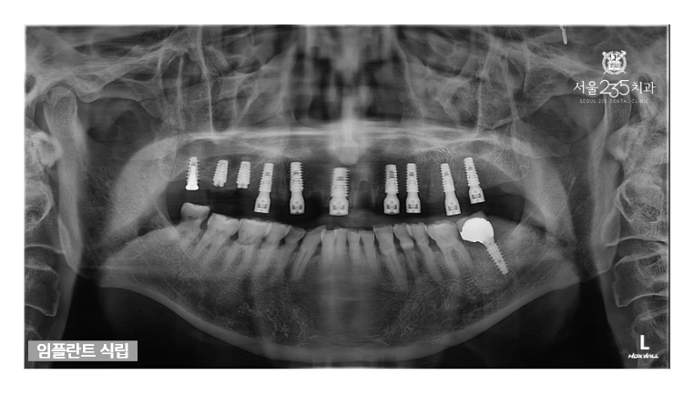 전악 임플란트 상악 x-ray 파노라마