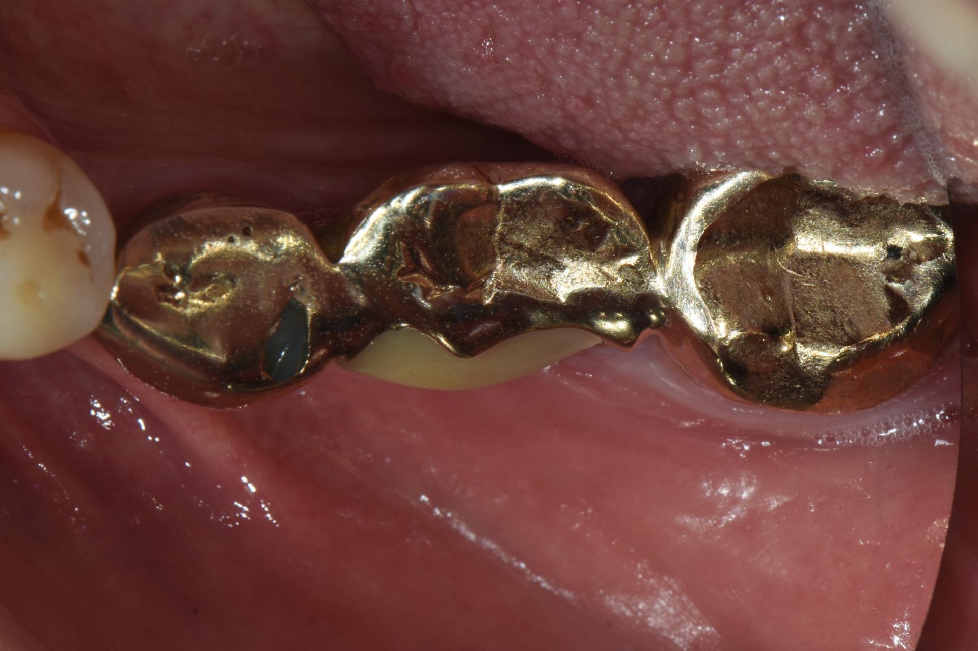 보철물 마모파절