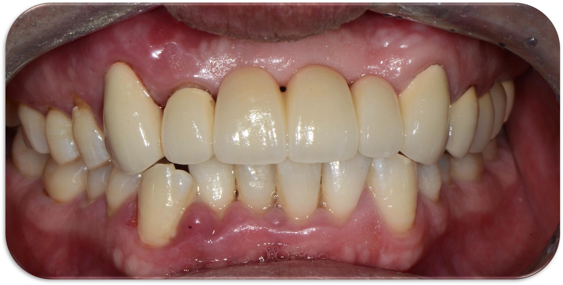 재보철치료 후 상태