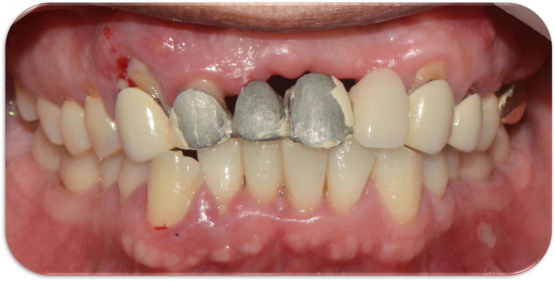 재보철치료 전 상태