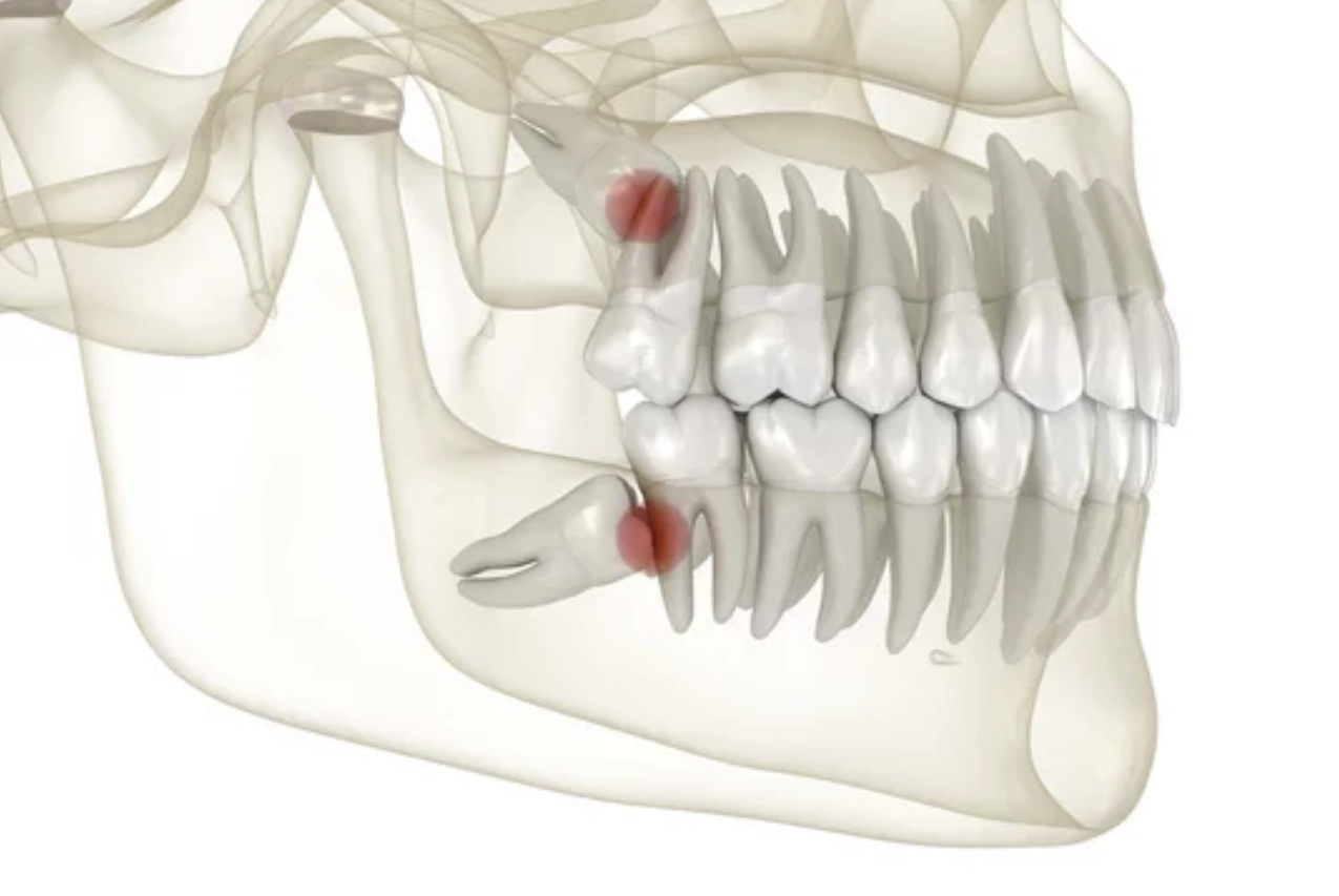 사랑니 위치 해부도