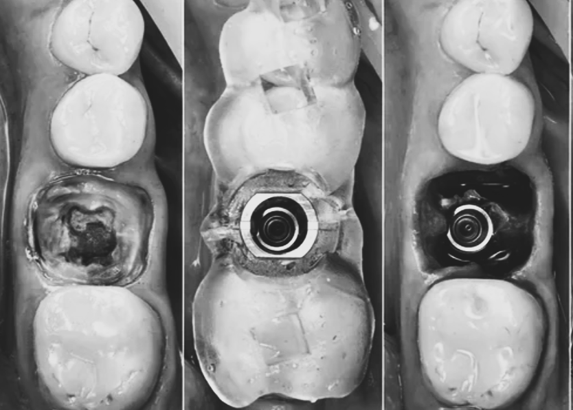 발치 즉시 식립