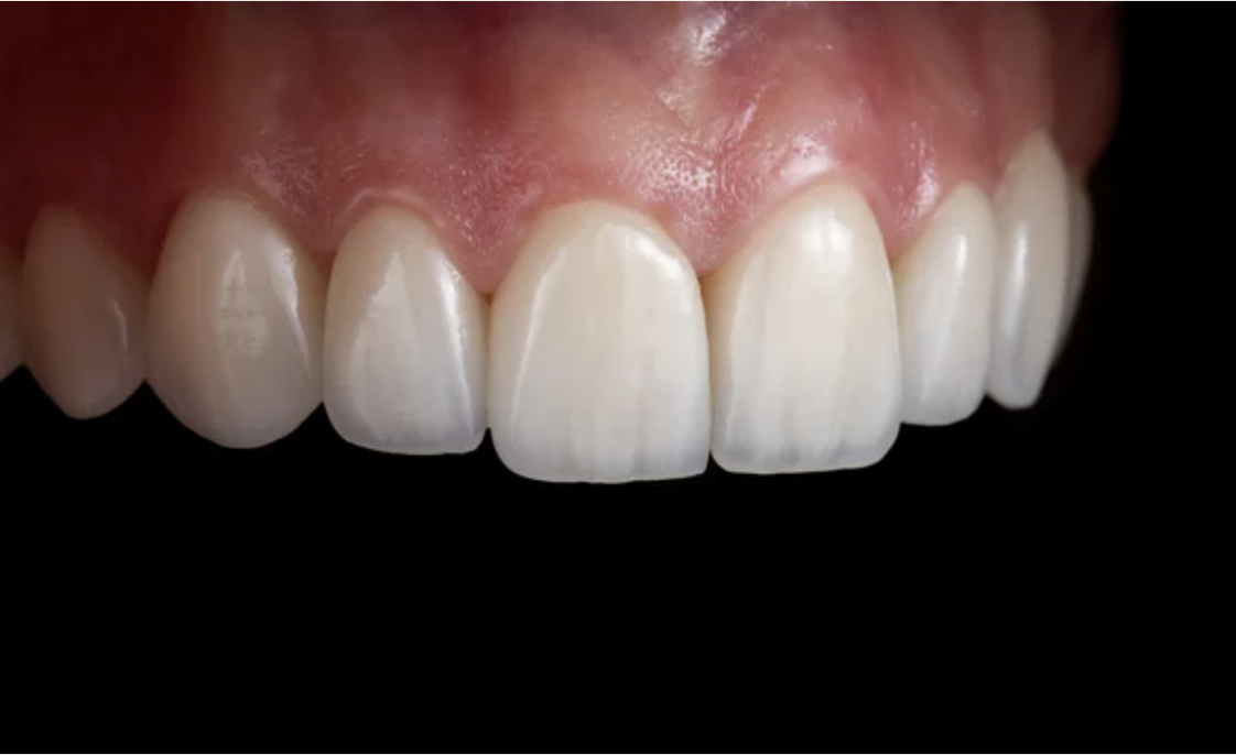 라미네이트 치료효과