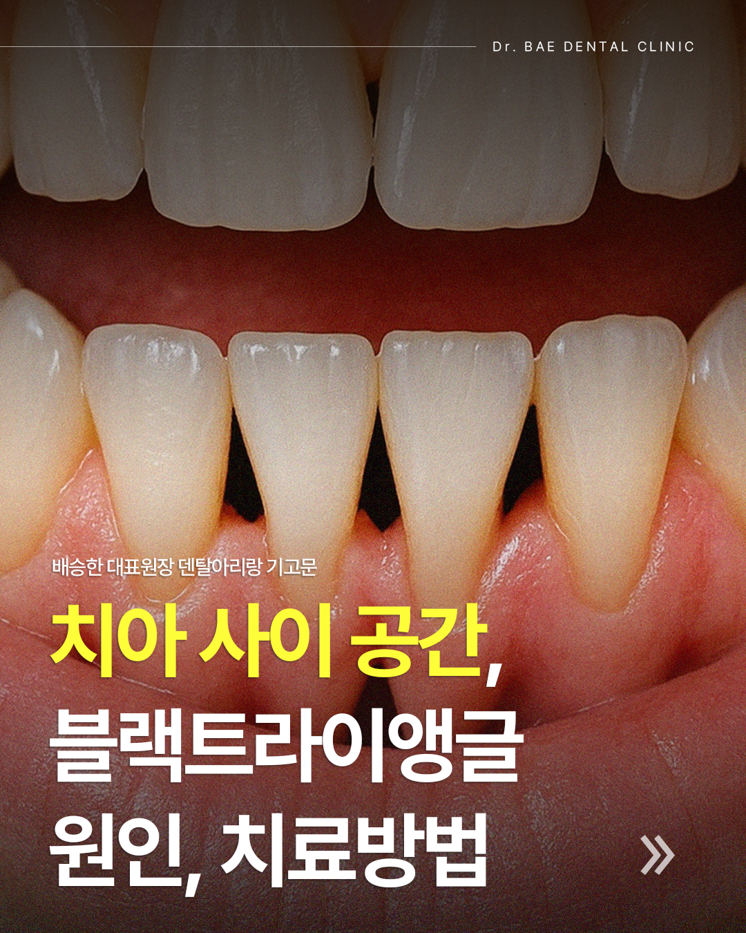 성공률 95%, 당뇨 임플란트의 오해와 진실 : 원데이치과 블로그, image size:1080x1350