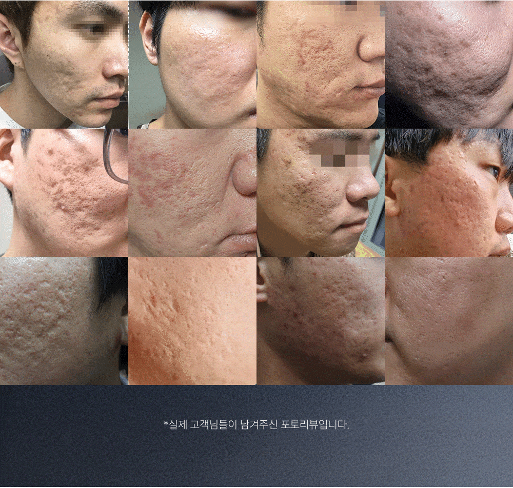 2시간 뒤 가격 상승💸 흉터성모공 개선 실험 성공! 피부과 모공슈링커 비밀특가