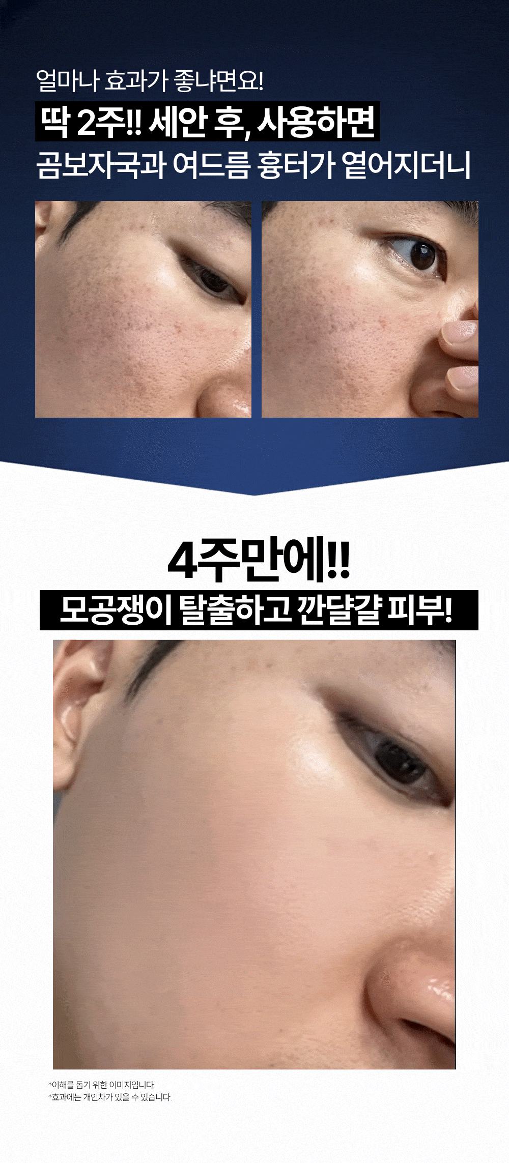 2시간 뒤 가격 상승💸 흉터성모공 개선 실험 성공! 피부과 모공슈링커 비밀특가