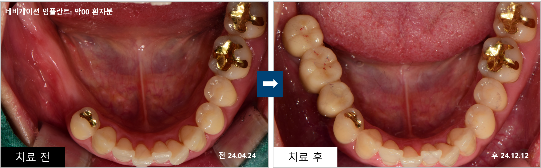 김포치과 어금니 임플란트