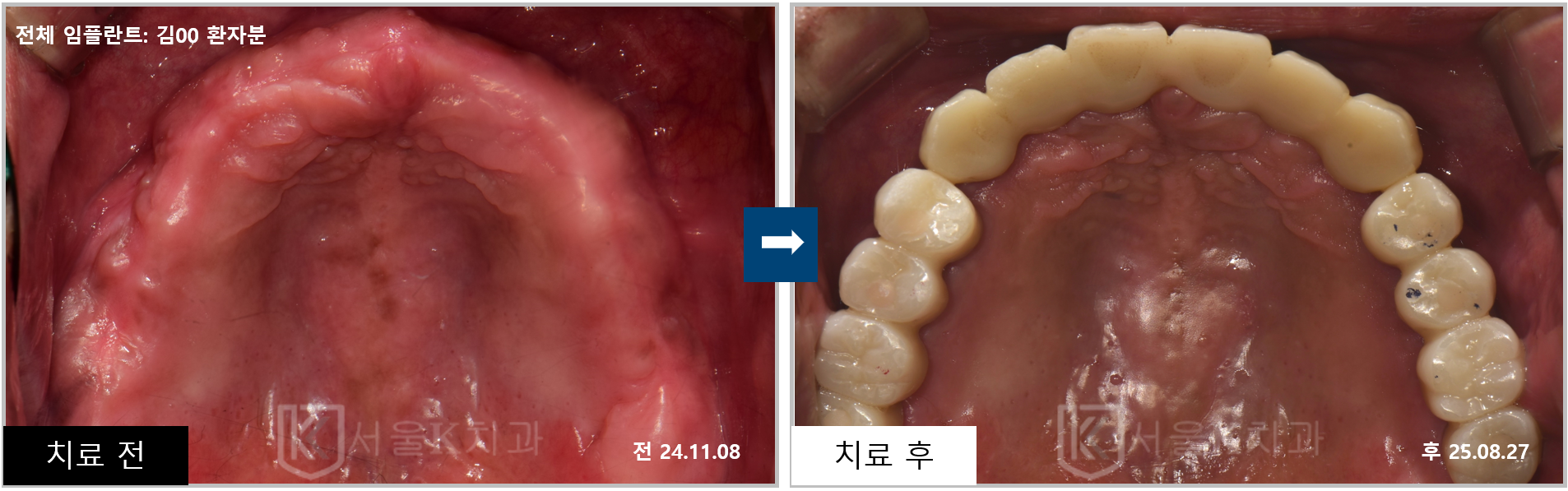 김포 임플란트 전체 치료 사례