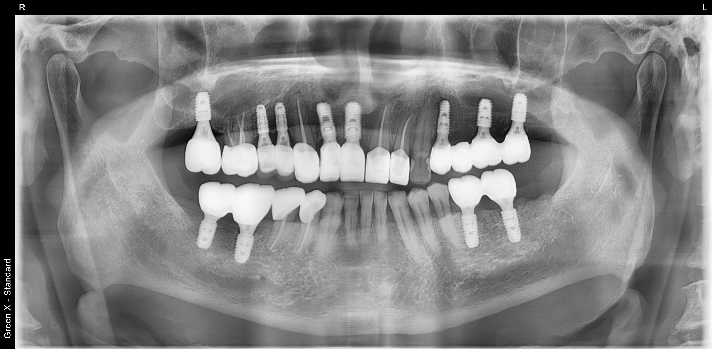 풍무동 치과 임플란트 치료 후
