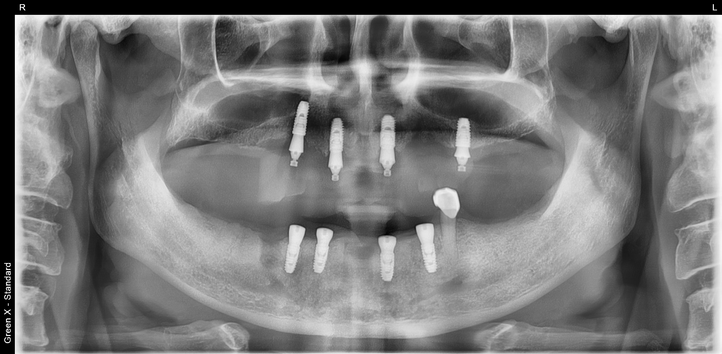 고촌치과 임플란트 식립 후