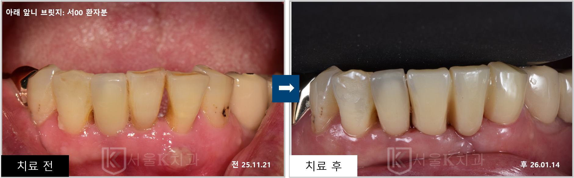 풍무동치과 앞니 브릿지