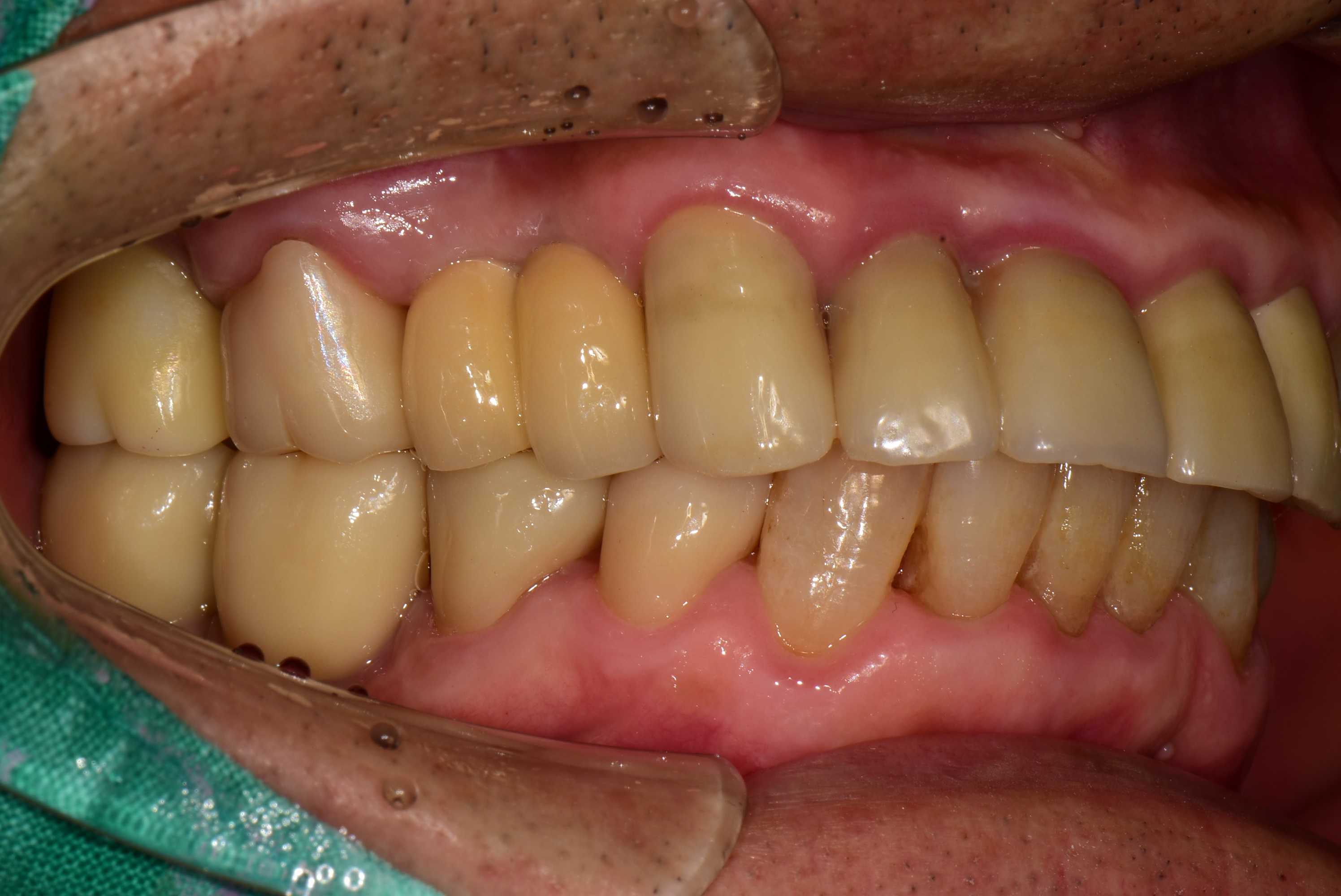 풍무동치과 어금니 임플란트.