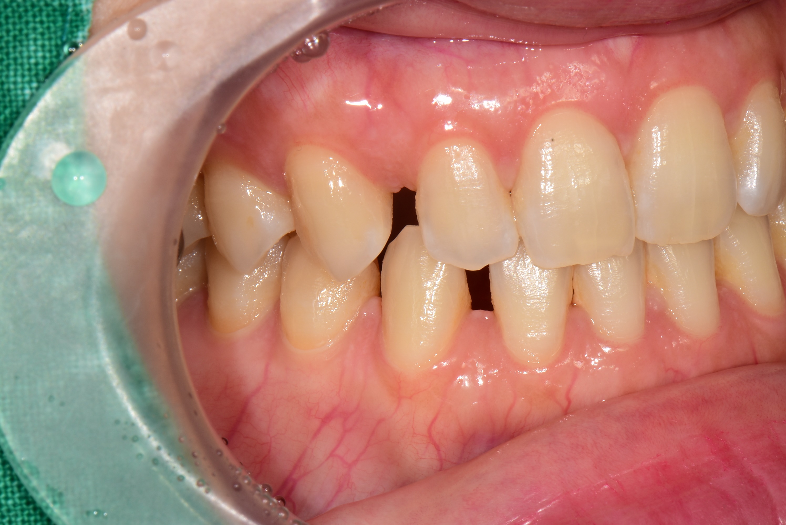 김포치과 라미네이트 전