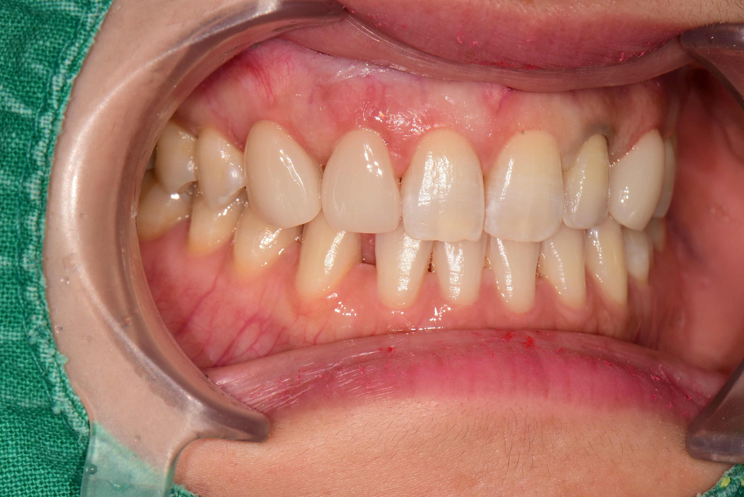 김포치과 라미네이트 후