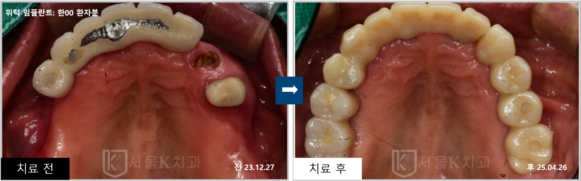 풍무동 서울케이치과 위턱 다수치아 임플란트