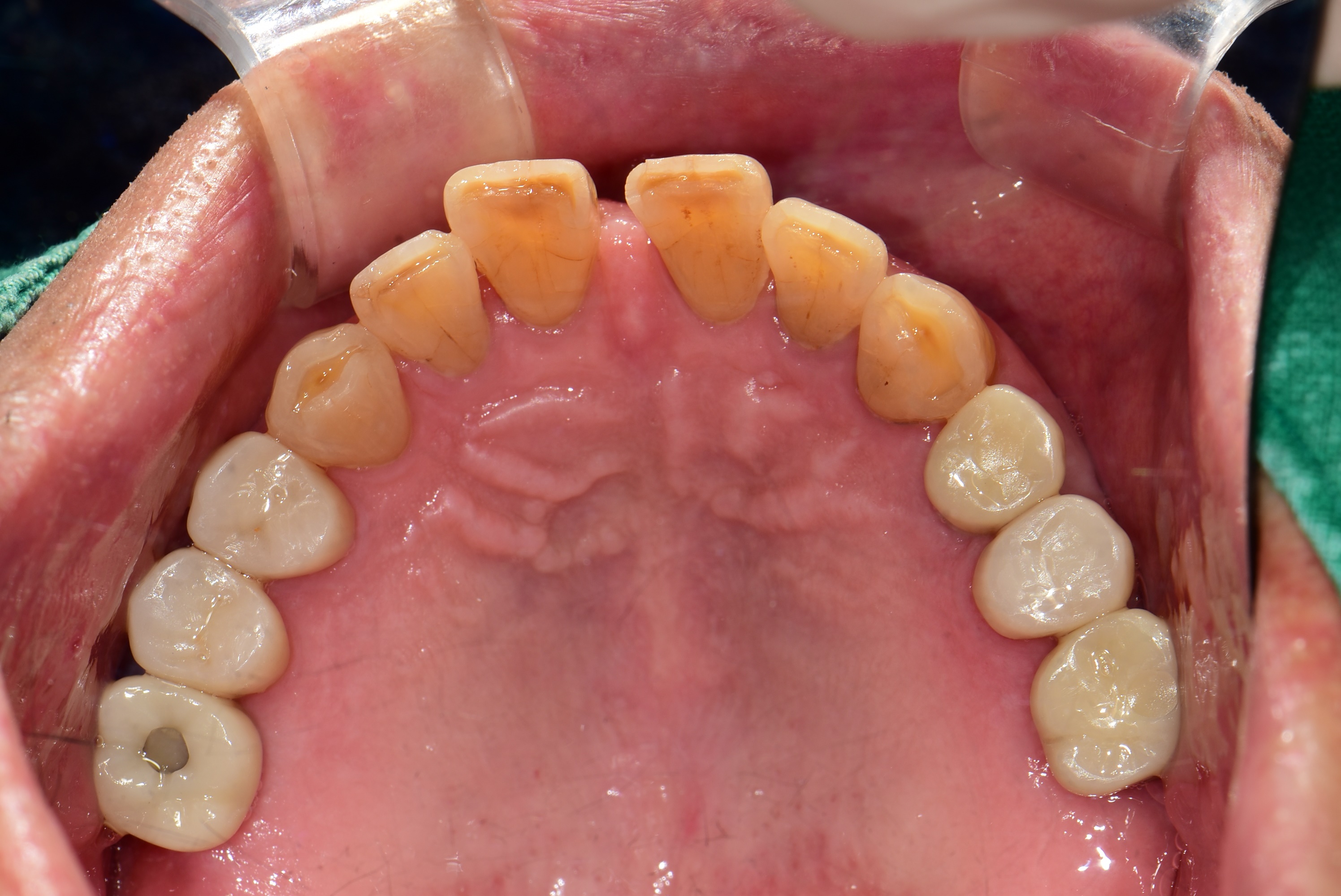 김포치과 어금니 임플란트