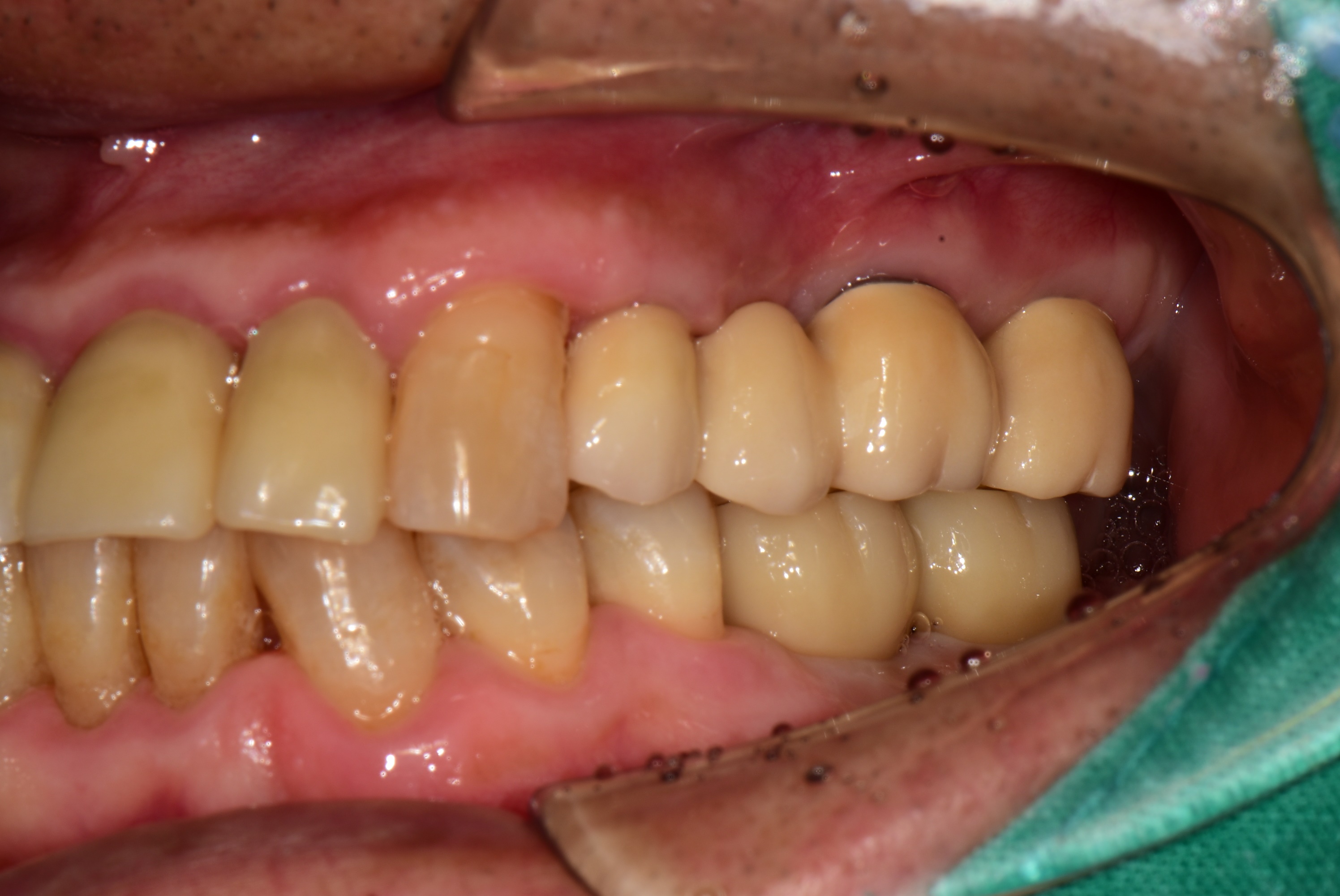 풍무동치과 어금니 임플란트
