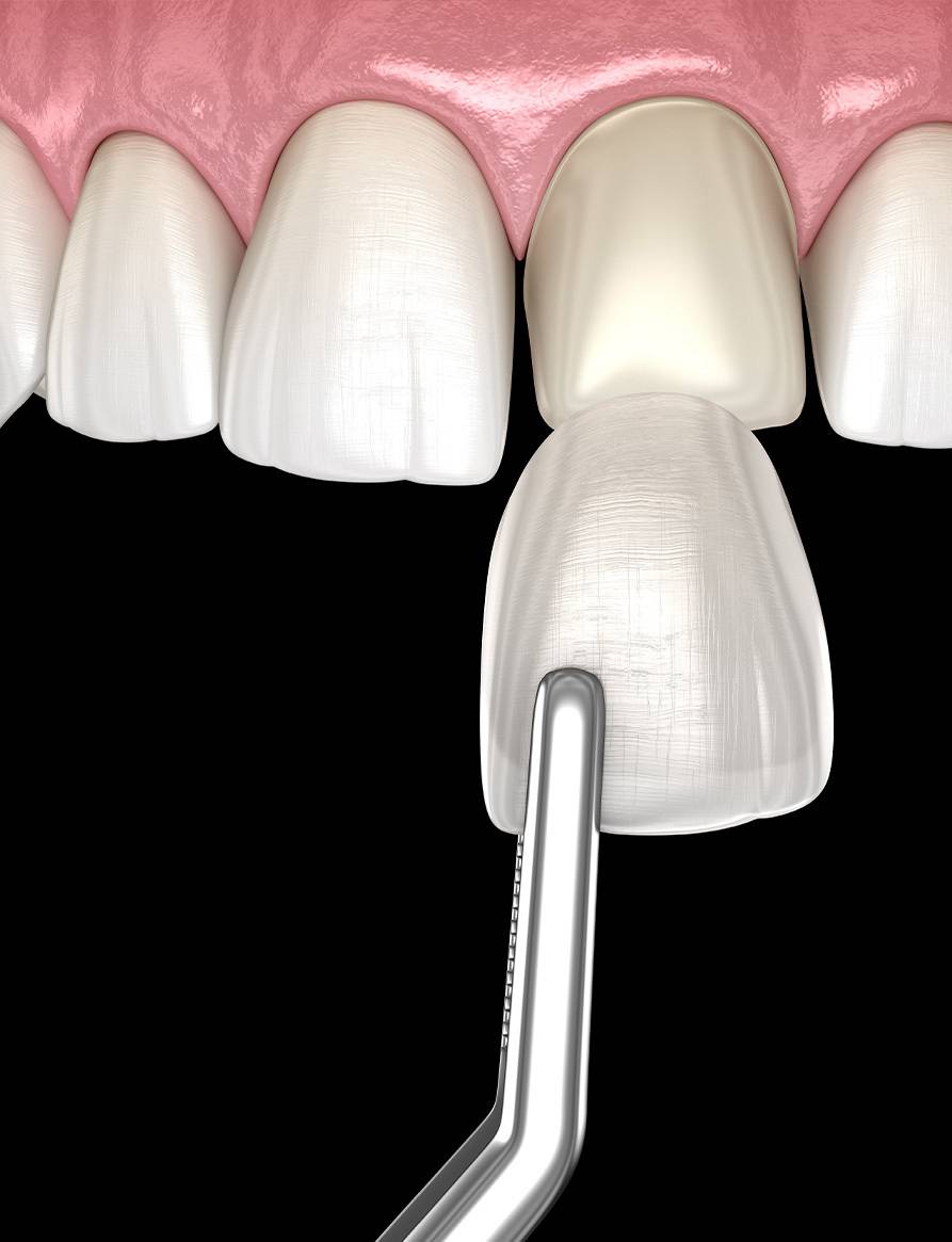 서울케이치과의 앞니에 라미네이트를 부착하는 치아 성형 시술 과정의 3D 일러스트