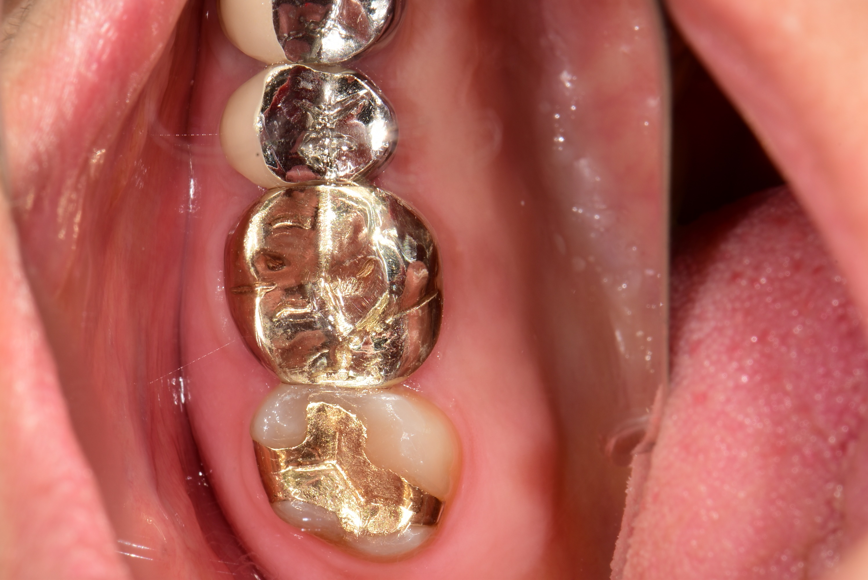 김포치과 골드 크라운