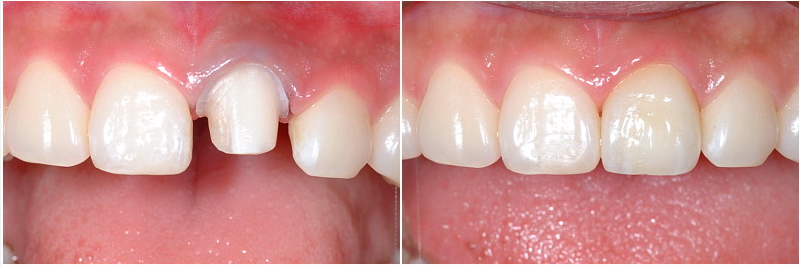 김포치과 앞니 올세라믹 크라운