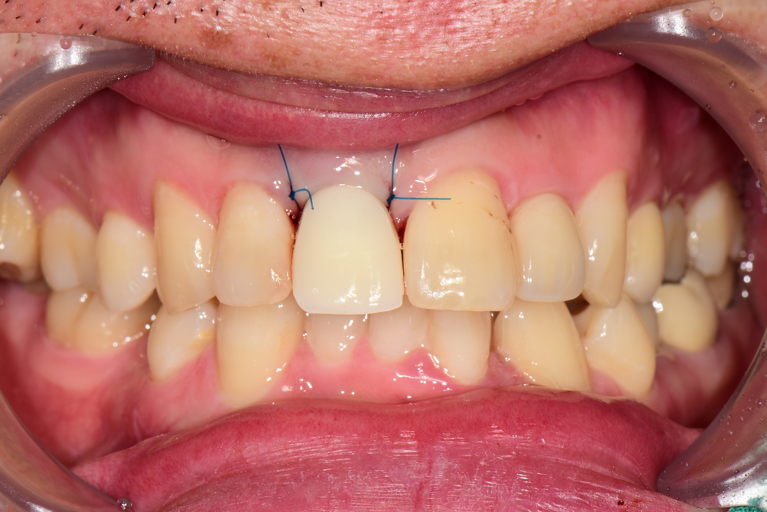 고촌치과 임플란트 즉시 임시치아