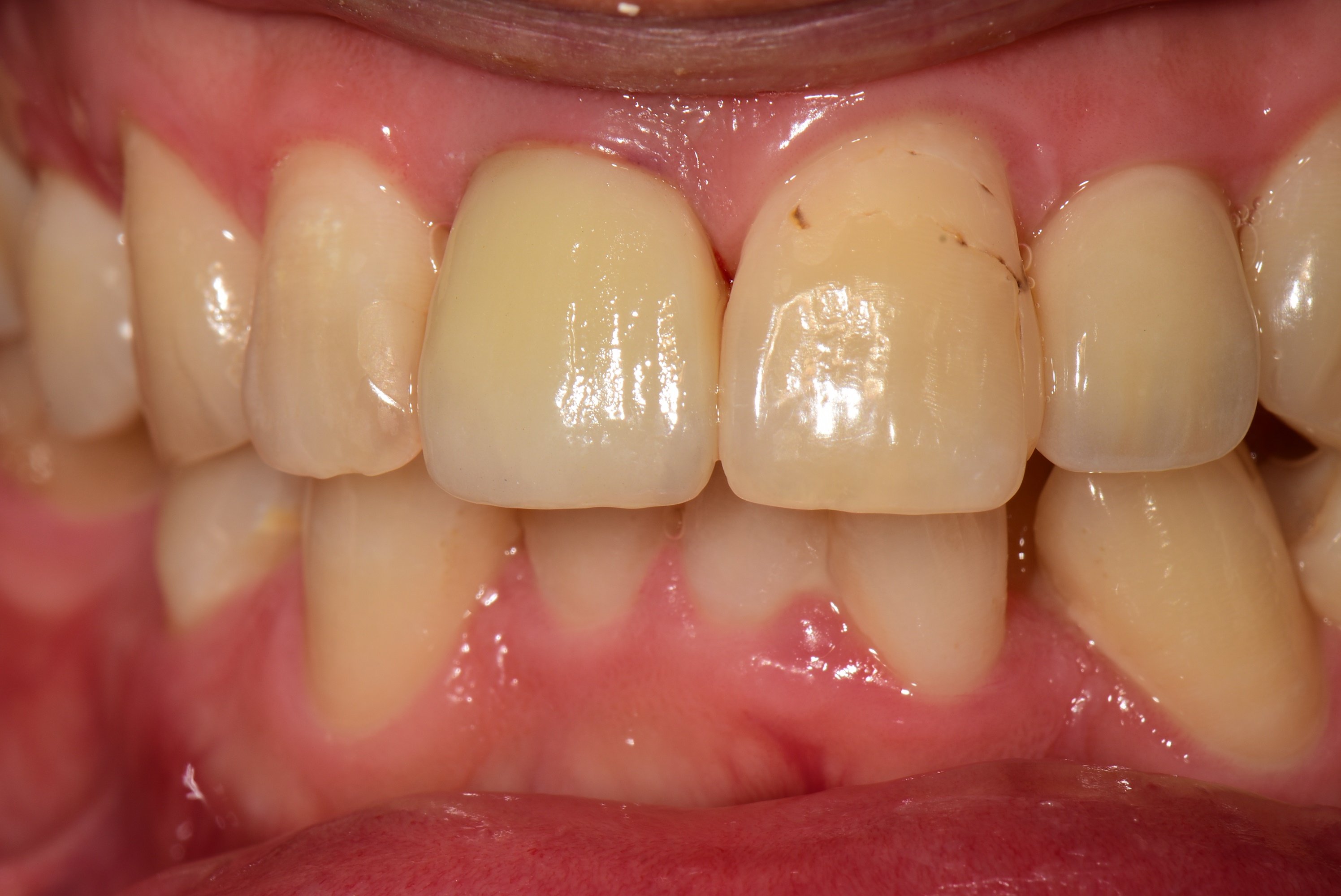 고촌치과, 앞니 임플란트