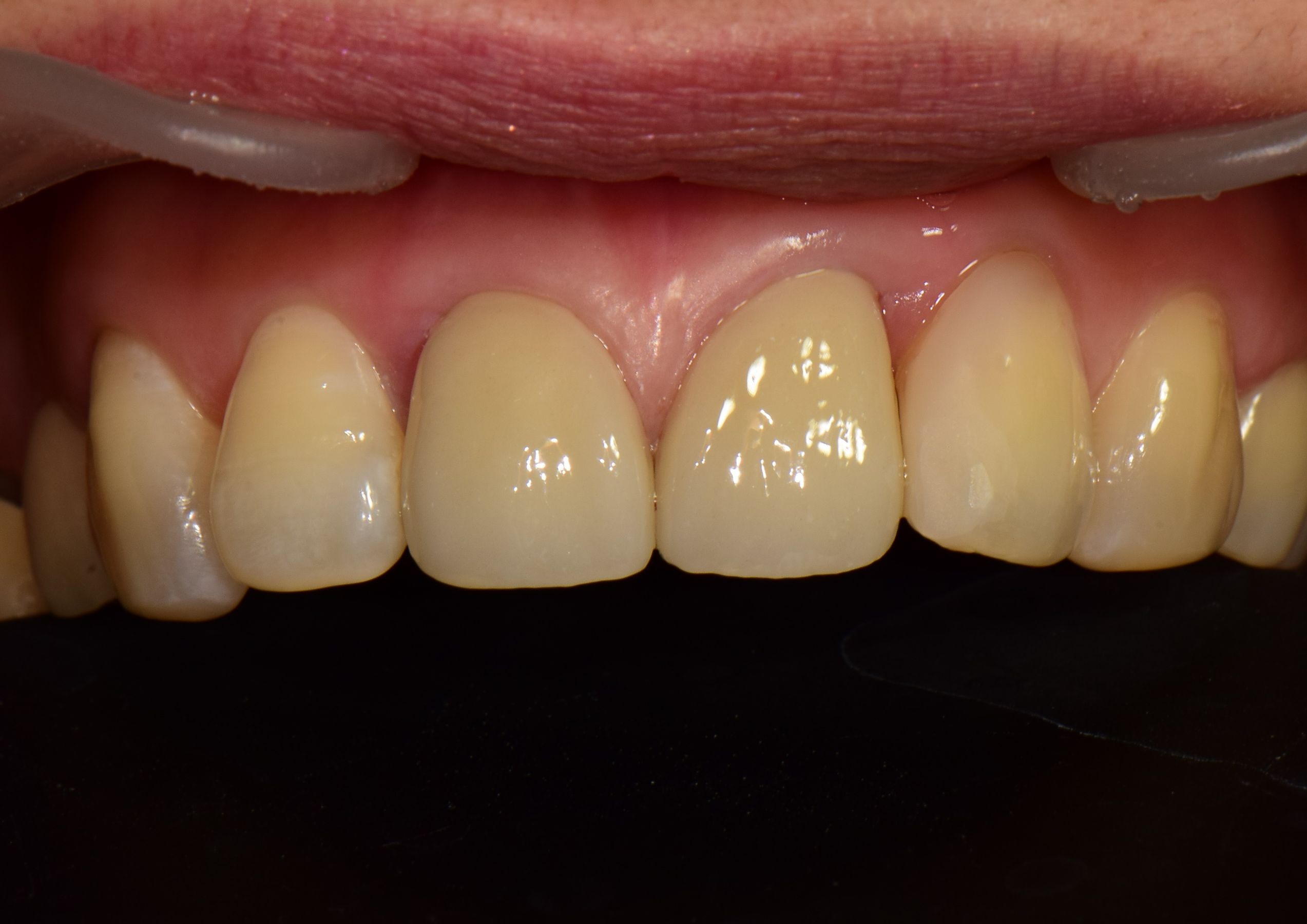 풍무동치과 앞니 지르코니아 크라운