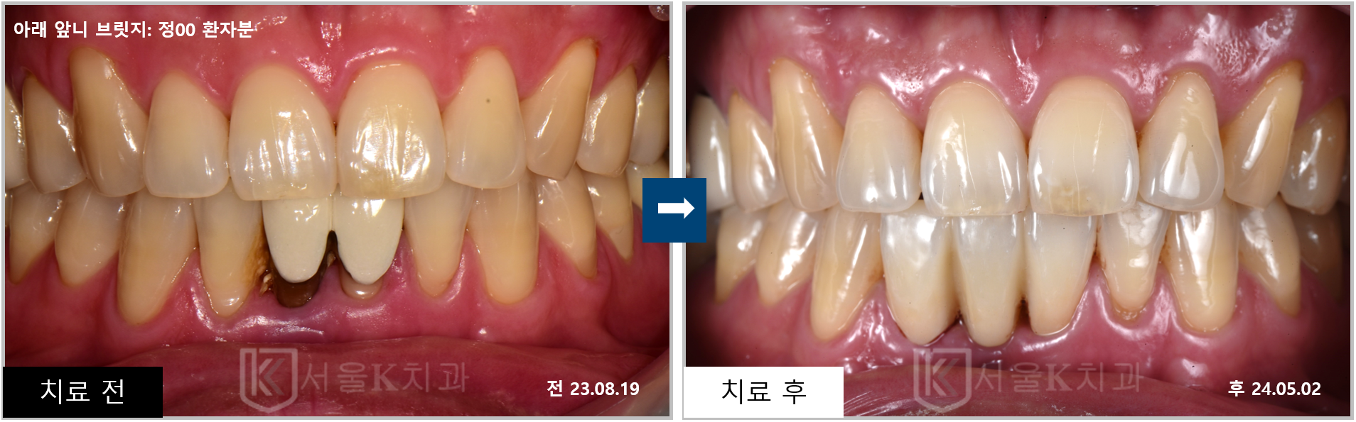 풍무동치과 앞니 브릿지