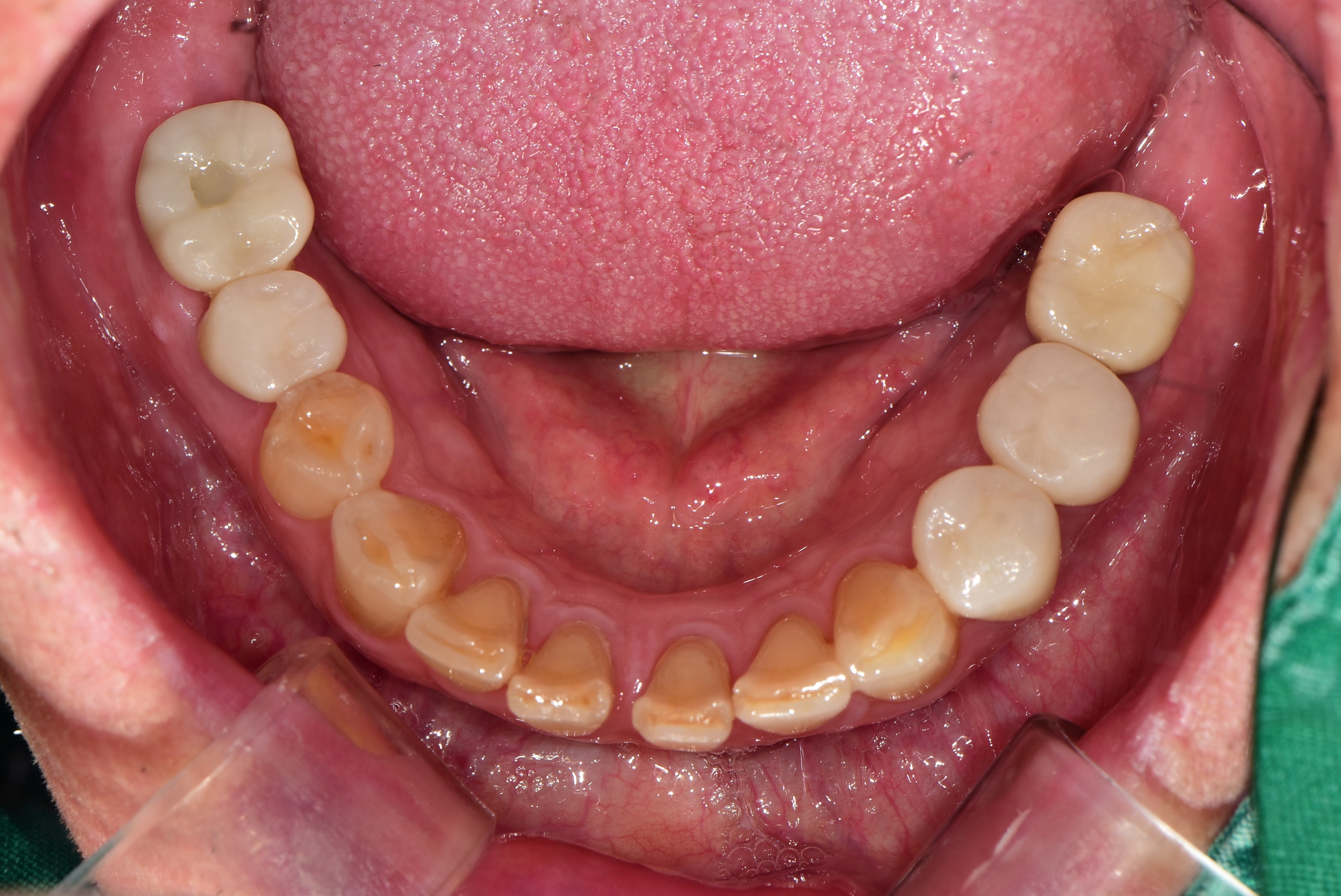 고촌치과 어금니 임플란트