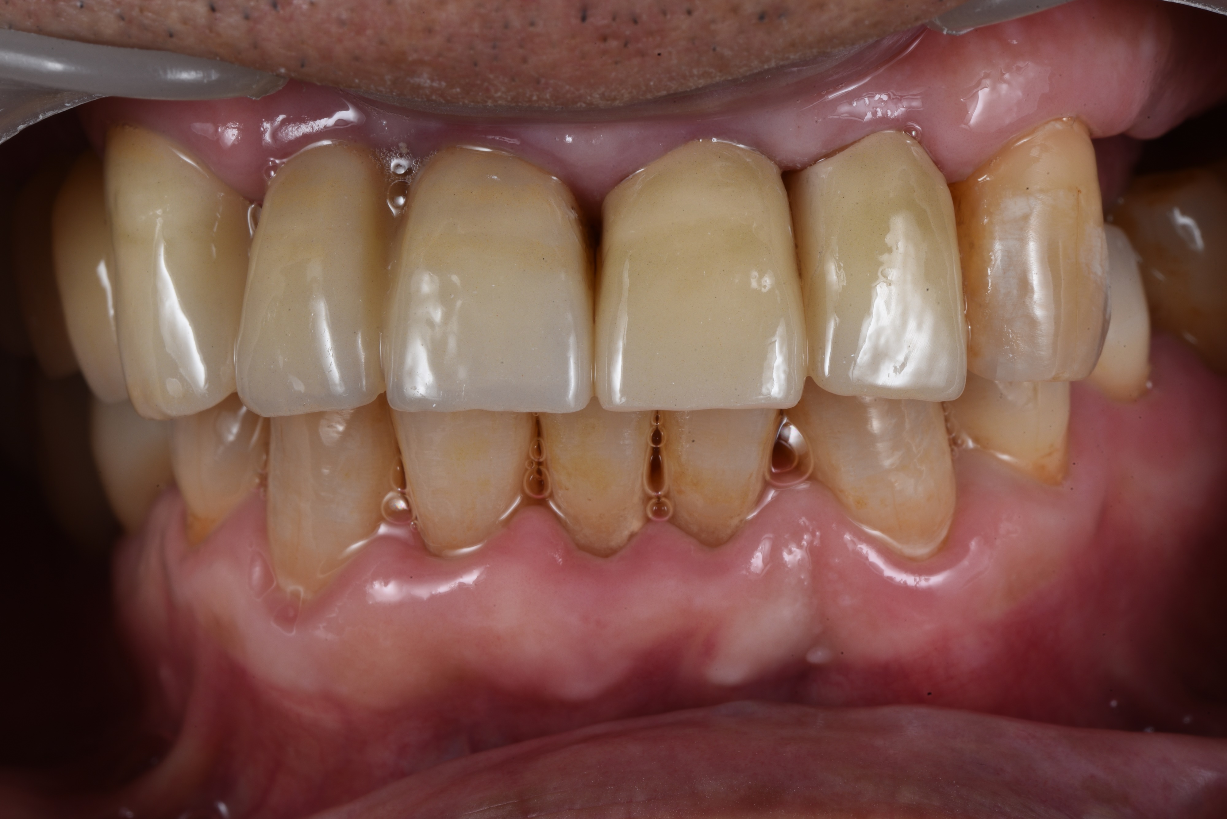 풍무동 앞니 임플란트