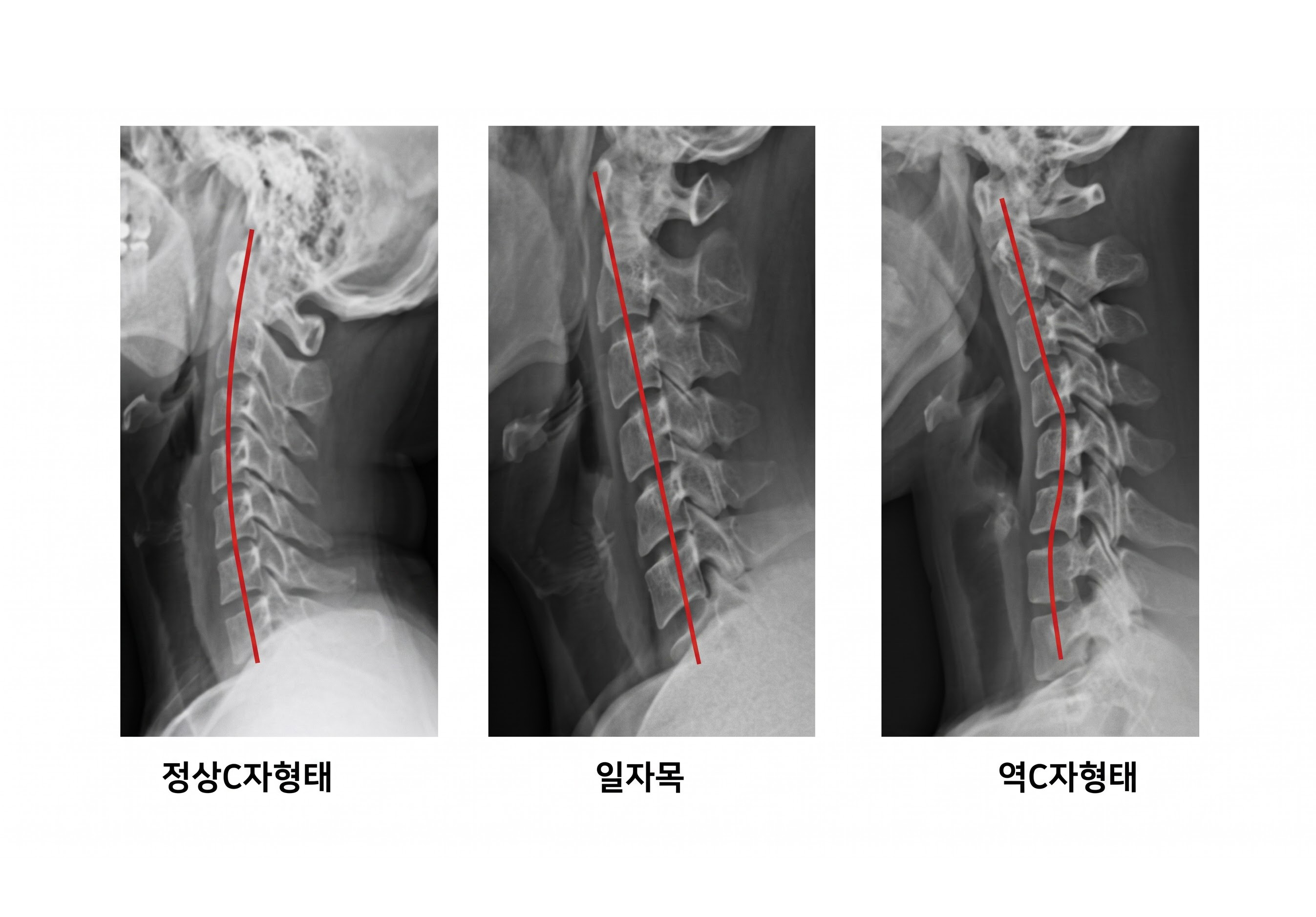 일자목 거북목 X-ray 비교 설명