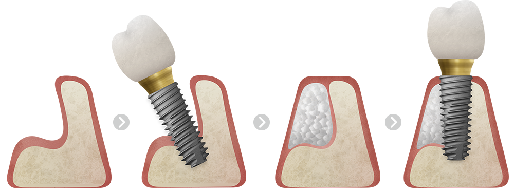 뼈이식 임플란트 식립 과정