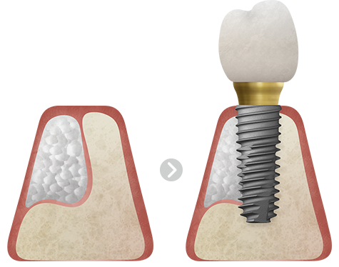 뼈이식 임플란트 식립 과정