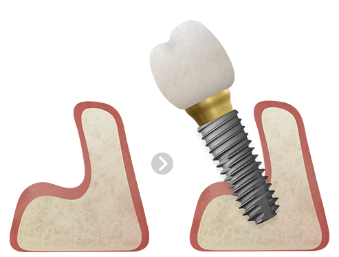 뼈이식 임플란트 식립 과정